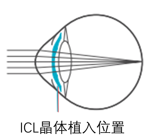 ICL晶体的介绍